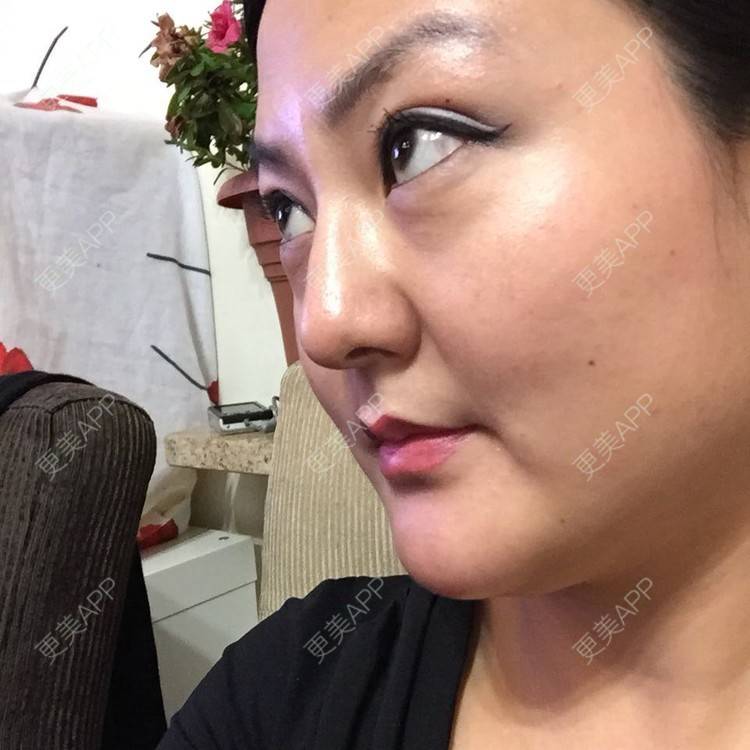 更美 - 玻尿酸丰下巴+玻尿酸填充泪沟+玻尿酸注射隆鼻+瘦脸针的日记p | 玻尿酸泪沟 | 除皱瘦脸 | 玻尿酸苹果肌 | 玻尿酸下巴 | 信阳