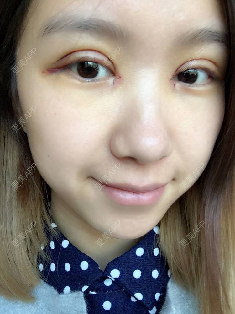 开内眼角切开双眼皮的日记