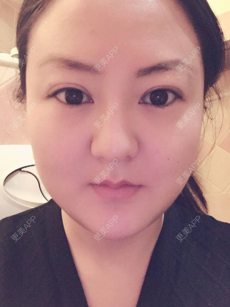 更美 - 玻尿酸丰下巴+玻尿酸填充泪沟+玻尿酸注射隆鼻+瘦脸针的日记p | 玻尿酸泪沟 | 除皱瘦脸 | 玻尿酸苹果肌 | 玻尿酸下巴 | 信阳