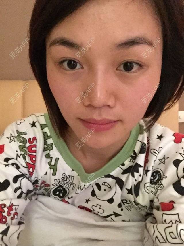 更美 - 双下巴激光溶脂+吸脂减双下巴+宽下巴矫正+果酸美白+光子嫩肤+e光美肤+美白+玻尿酸保湿+祛痘+去黑头+黑脸娃娃缩毛孔+激光面部提升+祛红血丝+像素激光+硅胶隆鼻+肿泡眼+眼眉其他+自体脂肪泪沟的日记 | 全切双眼皮 | 自体脂肪填充泪沟 | 眼部其他项目 | 宽下巴矫正 | 双下巴溶脂 | 红蓝光清痘 | 激光淡化红血丝 | 光子嫩肤 | 黑脸娃娃 | 硅胶隆鼻 | 双下巴吸脂 | 杭州