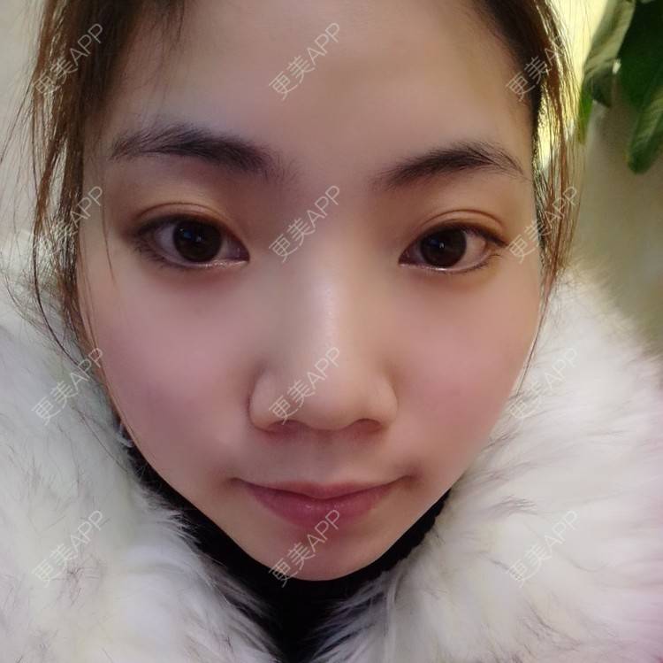 更美 - 缩小鼻小+下巴 | 鼻翼 | 南京