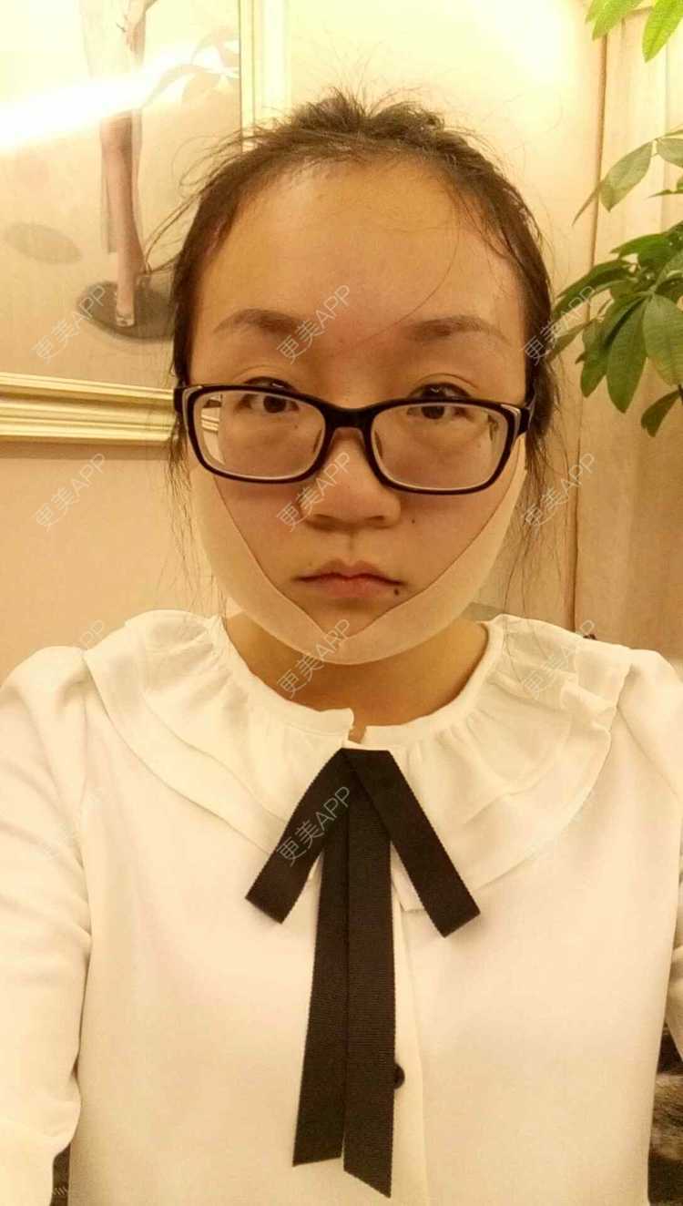 更美 - 双下巴激光溶脂+激光溶脂瘦脸 | 双下巴溶脂 | 激光溶脂瘦脸 | 深圳