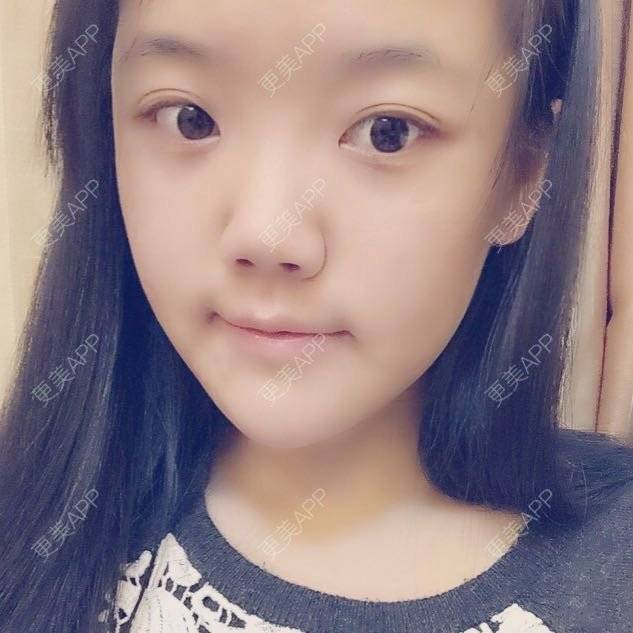 更美 - 玻尿酸丰太阳穴+玻尿酸丰下巴的日记 | 除皱瘦脸 | 玻尿酸下巴 | 玻尿酸太阳穴 | 上海