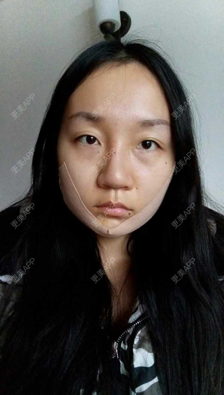 更美 - 双下巴激光溶脂+激光溶脂瘦脸 | 双下巴溶脂 | 激光溶脂瘦脸 | 深圳