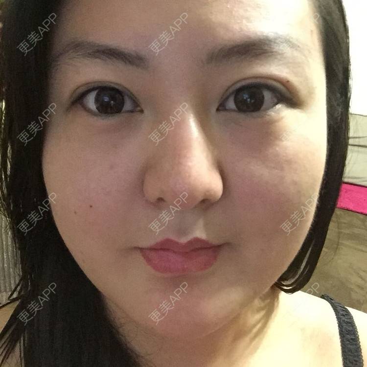 更美 - 玻尿酸丰下巴+玻尿酸填充泪沟+玻尿酸注射隆鼻+瘦脸针的日记p | 玻尿酸泪沟 | 除皱瘦脸 | 玻尿酸苹果肌 | 玻尿酸下巴 | 信阳