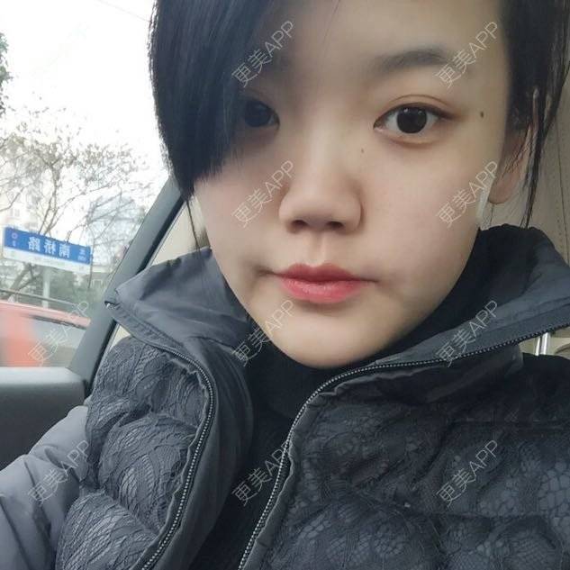 更美 - 玻尿酸丰太阳穴+玻尿酸丰下巴的日记 | 除皱瘦脸 | 玻尿酸下巴 | 玻尿酸太阳穴 | 上海