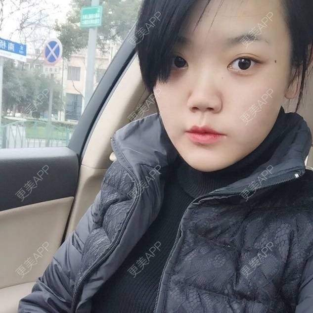 更美 - 玻尿酸丰太阳穴+玻尿酸丰下巴的日记 | 除皱瘦脸 | 玻尿酸下巴 | 玻尿酸太阳穴 | 上海