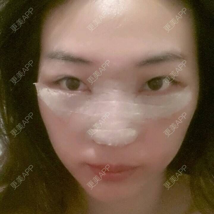 更美 - 硅胶隆鼻+内路祛眼袋 | 内切去眼袋 | 硅胶隆鼻 | 濮阳