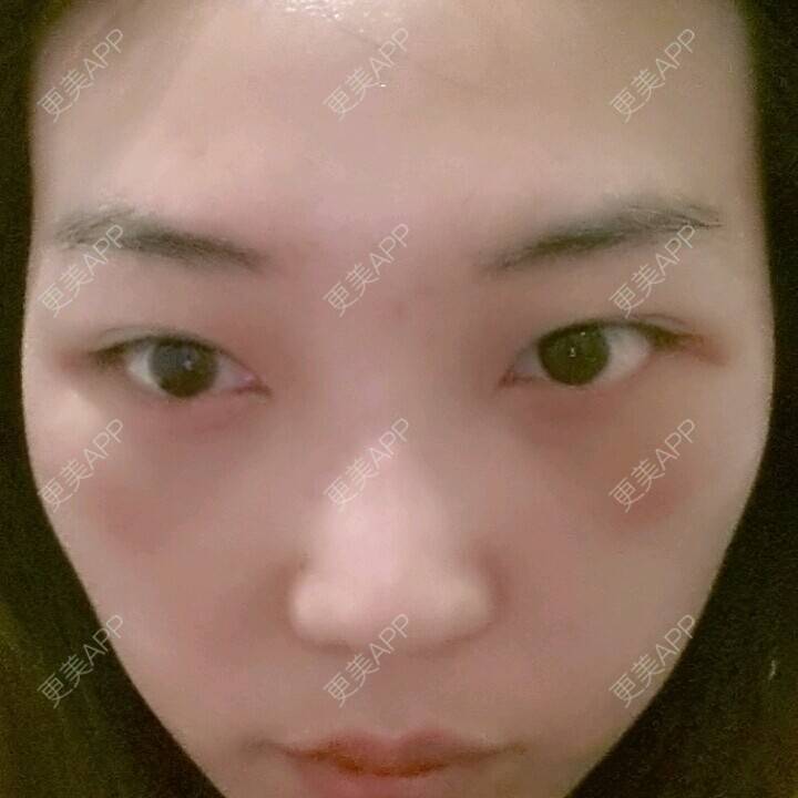 更美 - 硅胶隆鼻+激光祛眼袋 | 激光去眼袋 | 硅胶隆鼻 | 濮阳