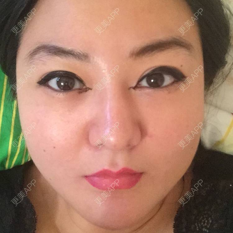 更美 - 玻尿酸丰下巴+玻尿酸填充泪沟+玻尿酸注射隆鼻+瘦脸针的日记p | 玻尿酸泪沟 | 除皱瘦脸 | 玻尿酸苹果肌 | 玻尿酸下巴 | 信阳