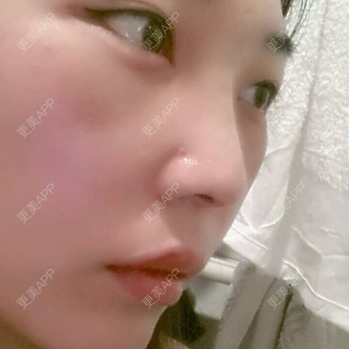 更美 - 硅胶隆鼻+激光祛眼袋 | 激光去眼袋 | 硅胶隆鼻 | 濮阳
