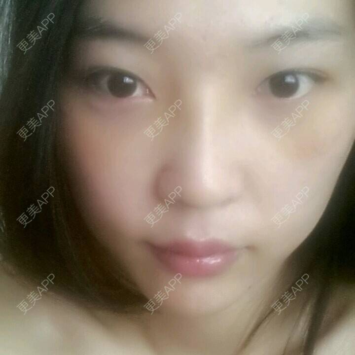 更美 - 激光祛眼袋+硅胶隆鼻 | 激光去眼袋 | 硅胶隆鼻 | 濮阳