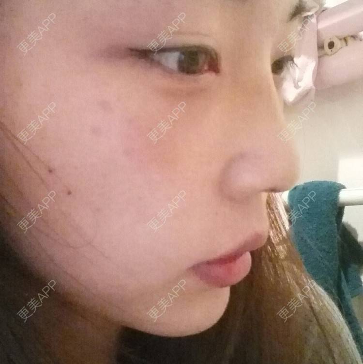 更美 - 硅胶隆鼻+激光祛眼袋 | 激光去眼袋 | 硅胶隆鼻 | 濮阳
