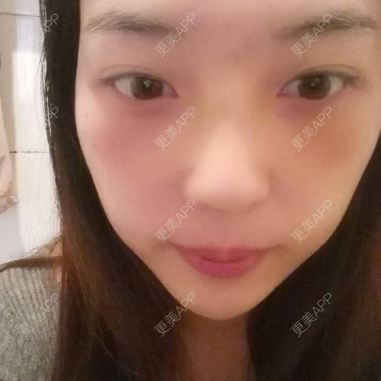 更美 - 硅胶隆鼻+激光祛眼袋 | 激光去眼袋 | 硅胶隆鼻 | 濮阳