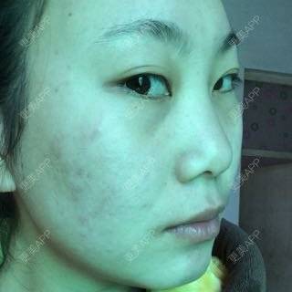 更美 - 自体脂肪隆鼻+玻尿酸隆鼻+玻尿酸注射隆鼻+膨体隆鼻+开内眼角+激光祛黑眼圈+自体脂肪泪沟+玻尿酸填充卧蚕+玻尿酸丰苹果肌+膨体丰额头+瘦脸针+激光祛痘+光子嫩肤+植发际线+植眉+植睫毛+牙齿美白的日记 | 开内眼角 | 玻尿酸卧蚕 | 自体脂肪填充泪沟 | 激光淡化黑眼圈 | 自体脂肪隆鼻 | 玻尿酸鼻部 | 除皱瘦脸 | 玻尿酸苹果肌 | 膨体丰额头 | 牙齿美白 | 光子嫩肤 | 膨体隆鼻 | 红蓝光清痘 | 植发际线 | 上海