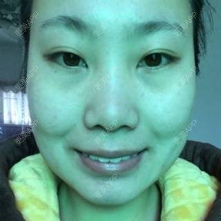 更美 - 自体脂肪隆鼻+玻尿酸隆鼻+玻尿酸注射隆鼻+膨体隆鼻+开内眼角+激光祛黑眼圈+自体脂肪泪沟+玻尿酸填充卧蚕+玻尿酸丰苹果肌+膨体丰额头+瘦脸针+激光祛痘+光子嫩肤+植发际线+植眉+植睫毛+牙齿美白的日记 | 开内眼角 | 玻尿酸卧蚕 | 自体脂肪填充泪沟 | 激光淡化黑眼圈 | 自体脂肪隆鼻 | 玻尿酸鼻部 | 除皱瘦脸 | 玻尿酸苹果肌 | 膨体丰额头 | 牙齿美白 | 光子嫩肤 | 膨体隆鼻 | 红蓝光清痘 | 植发际线 | 上海