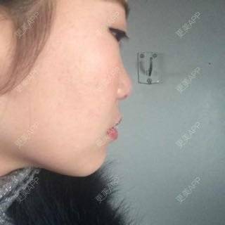 更美 - 自体脂肪隆鼻+玻尿酸隆鼻+玻尿酸注射隆鼻+膨体隆鼻+开内眼角+激光祛黑眼圈+自体脂肪泪沟+玻尿酸填充卧蚕+玻尿酸丰苹果肌+膨体丰额头+瘦脸针+激光祛痘+光子嫩肤+植发际线+植眉+植睫毛+牙齿美白的日记 | 开内眼角 | 玻尿酸卧蚕 | 自体脂肪填充泪沟 | 激光淡化黑眼圈 | 自体脂肪隆鼻 | 玻尿酸鼻部 | 除皱瘦脸 | 玻尿酸苹果肌 | 膨体丰额头 | 牙齿美白 | 光子嫩肤 | 膨体隆鼻 | 红蓝光清痘 | 植发际线 | 上海