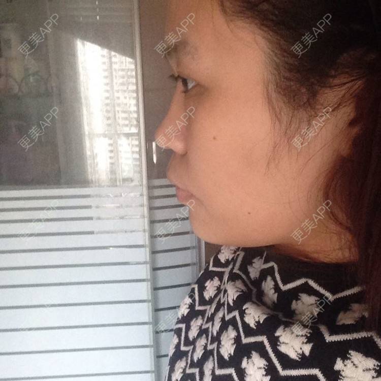 更美 - 请问专家我这样的鼻子需要做哪些整形？单纯隆鼻可以吗？ | 鼻部多项 | 南京