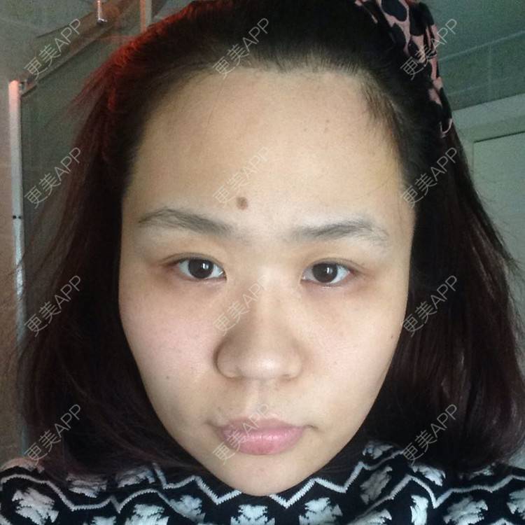 更美 - 请问专家我这样的鼻子需要做哪些整形？单纯隆鼻可以吗？ | 鼻部多项 | 南京