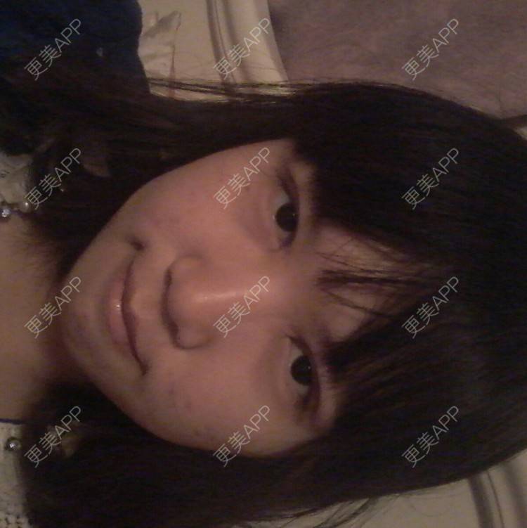更美 - 瘦脸针 | 除皱瘦脸 | 美购日记 | 石家庄