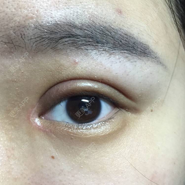 西安四医大切开双眼皮开内眼角的日记