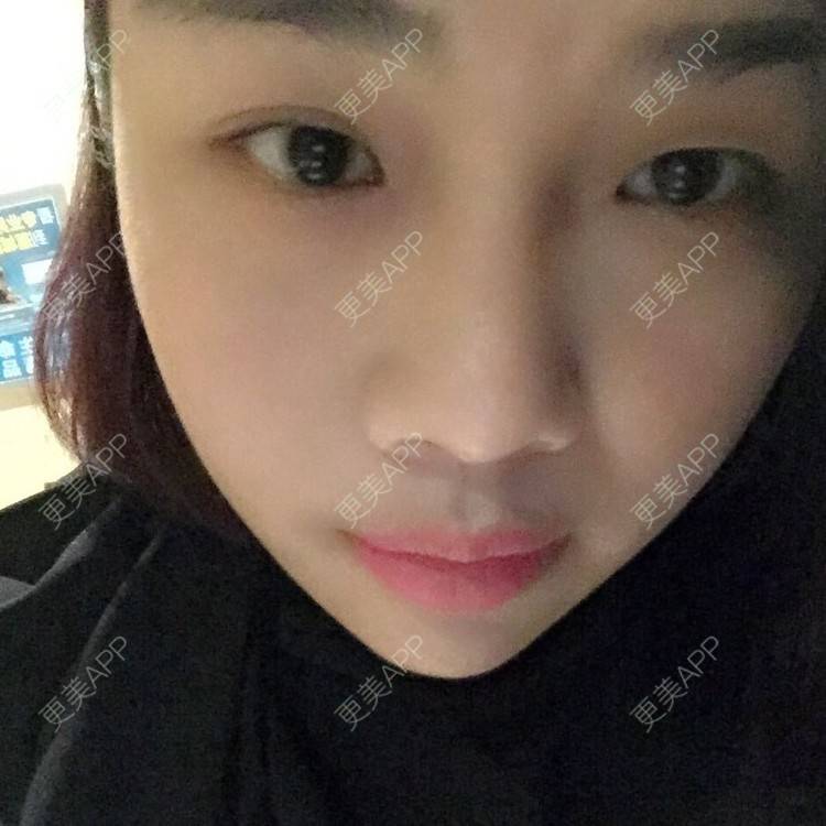 更美 - 切开双眼皮的日记 | 全切双眼皮 | 娄底