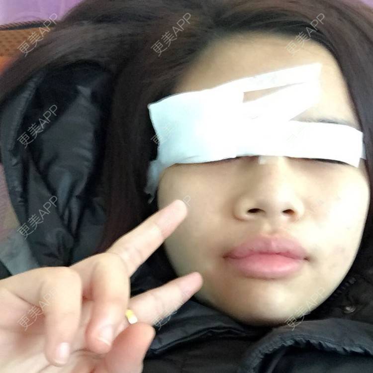 更美 - 切开双眼皮的日记 | 全切双眼皮 | 娄底