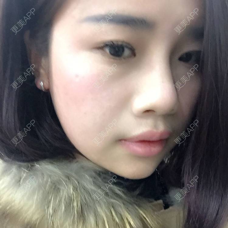 更美 - 切开双眼皮的日记 | 全切双眼皮 | 娄底