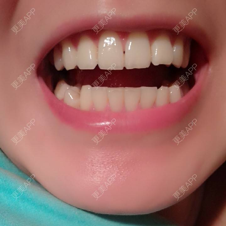 牙齿太大怎么办大板牙