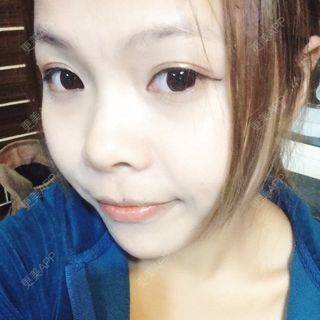 更美 - 自体脂肪隆鼻的日记 | 自体脂肪隆鼻 | 西安