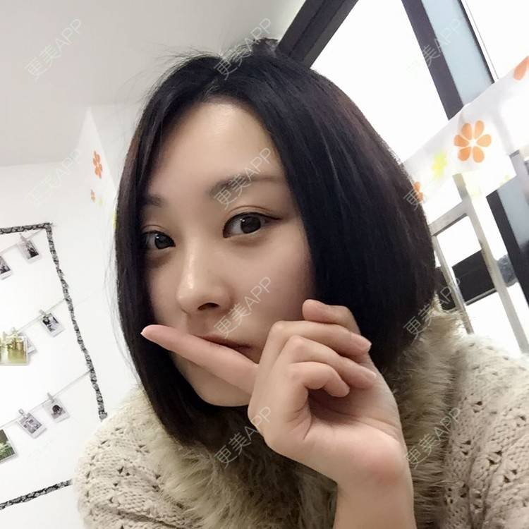 更美 - 切开双眼皮+上睑下垂+开内眼角的日记 | 全切双眼皮 | 开内眼角 | 眼皮下垂矫正 | 苏州