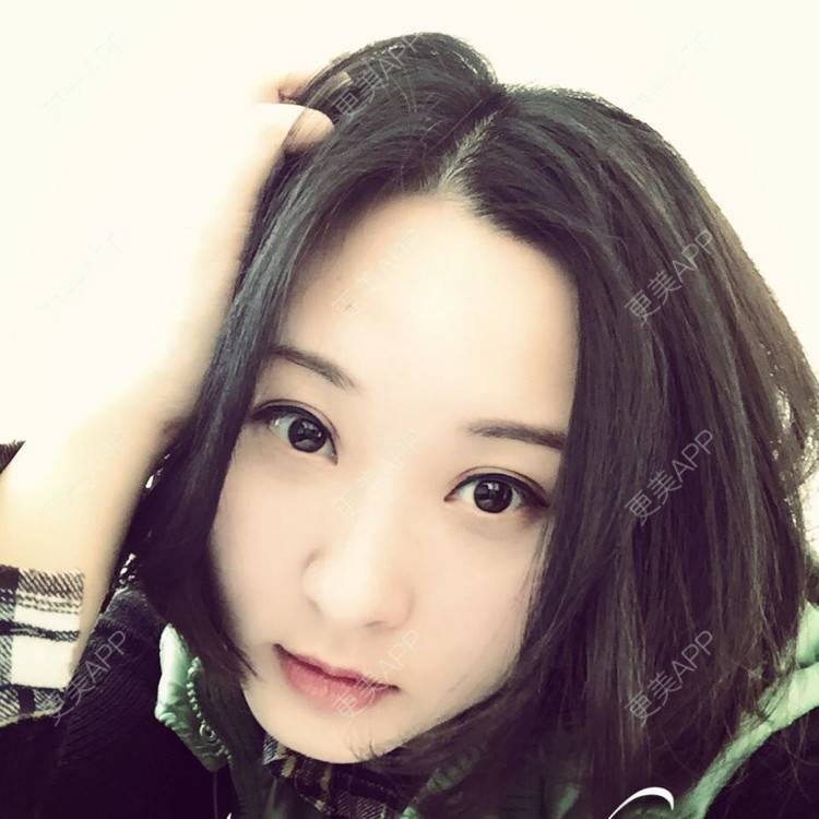 更美 - 切开双眼皮+上睑下垂+开内眼角的日记 | 全切双眼皮 | 开内眼角 | 眼皮下垂矫正 | 苏州