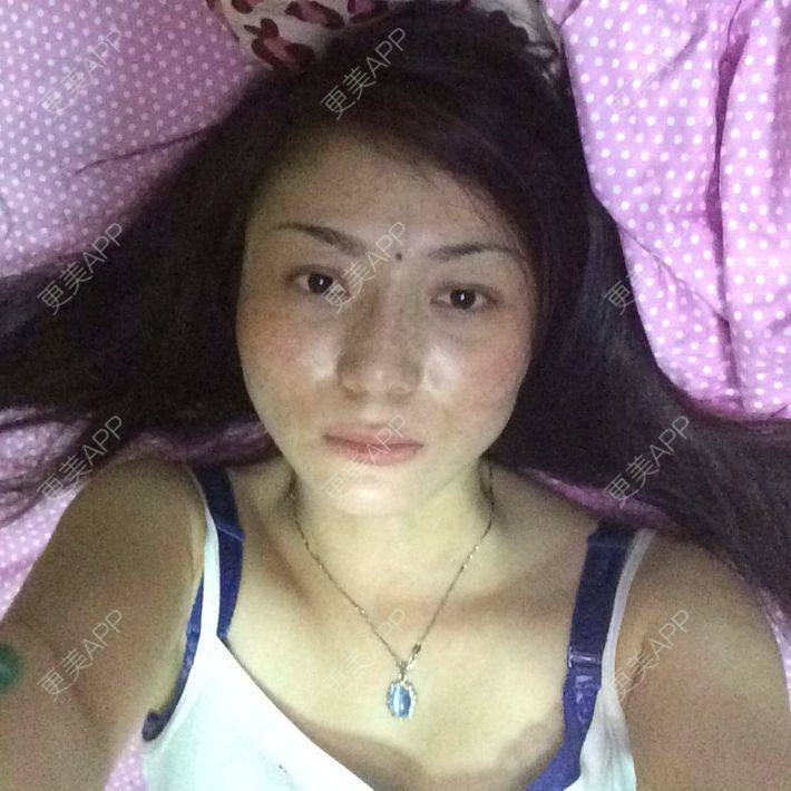 更美 - 我之前在南京华美做过但不好，没什么变化，我想这次做鼻子，希望大家给点健意 | 鼻部多项 | 黄山