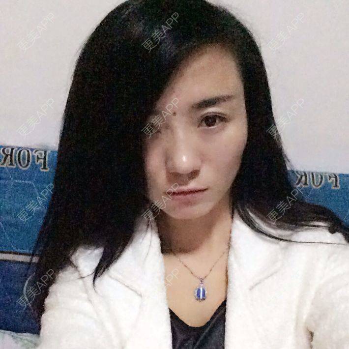 更美 - 我之前在南京华美做过但不好，没什么变化，我想这次做鼻子，希望大家给点健意 | 鼻部多项 | 黄山
