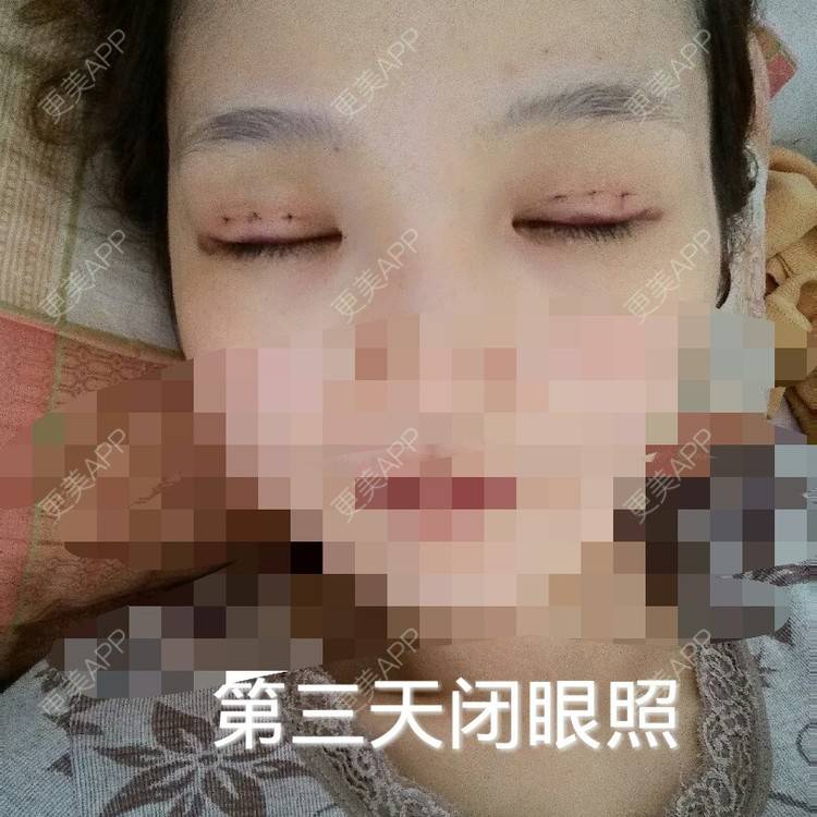 更美 - 多点双眼皮+上睑下垂 | 定点双眼皮 | 眼皮下垂矫正 | 九江