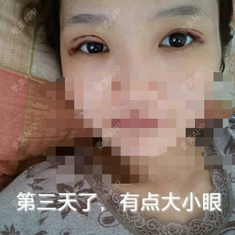 更美 - 多点双眼皮+上睑下垂 | 定点双眼皮 | 眼皮下垂矫正 | 九江