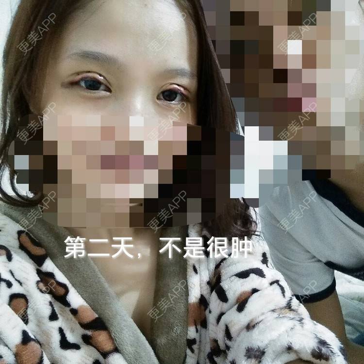 更美 - 多点双眼皮+上睑下垂 | 定点双眼皮 | 眼皮下垂矫正 | 九江