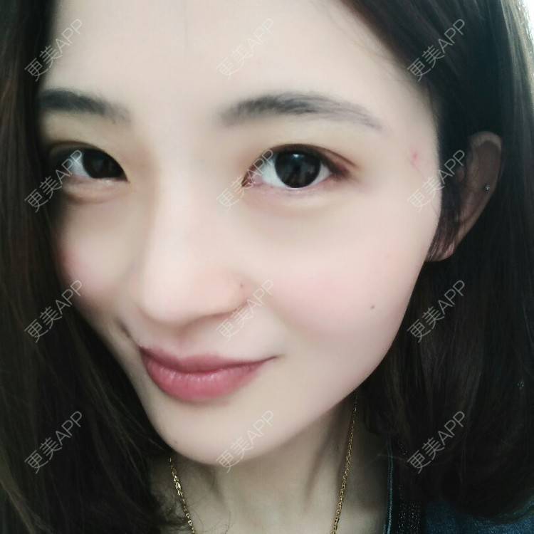 更美 - 果果雨0的定点双眼皮经验 | 定点双眼皮 | 眼皮下垂矫正 | 九江