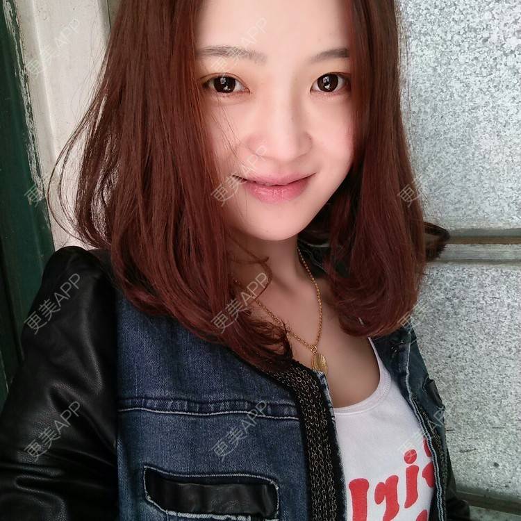 更美 - 果果雨0的定点双眼皮经验 | 定点双眼皮 | 眼皮下垂矫正 | 九江
