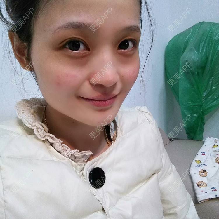 更美 - 果果雨0的定点双眼皮经验 | 定点双眼皮 | 眼皮下垂矫正 | 九江