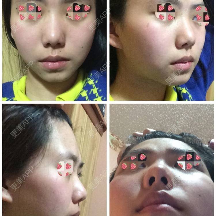 更美 - 鼻综合整形+鼻中隔软骨垫鼻头+硅胶隆鼻+耳软骨垫鼻头+鼻翼软骨缝合+宽鼻整形+软骨整形矫正短鼻+朝天鼻矫正术的日记 | 朝天鼻矫正 | 硅胶隆鼻 | 上海