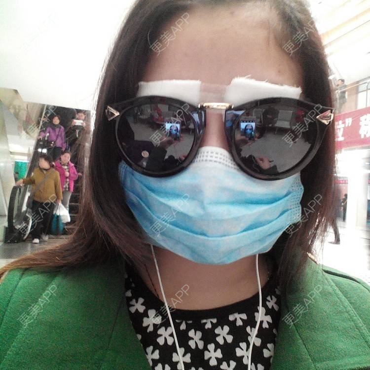 更美 - 切开双眼皮+上睑下垂 | 全切双眼皮 | 眼皮下垂矫正 | 南京 | 美购日记