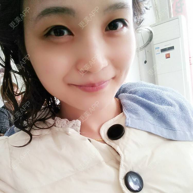 更美 - 果果雨0的定点双眼皮经验 | 定点双眼皮 | 眼皮下垂矫正 | 九江