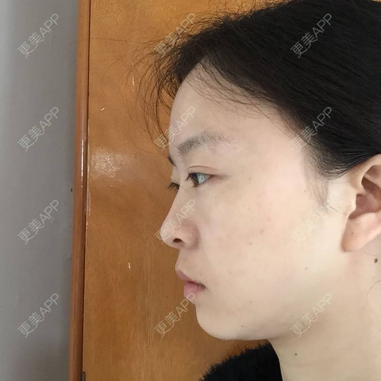 更美 - 自体脂肪丰下巴+自体脂肪丰面颊+太阳穴脂肪填充的日记 | 自体脂肪垫下巴 | 自体脂肪丰面颊 | 自体脂肪丰太阳穴 | 武汉