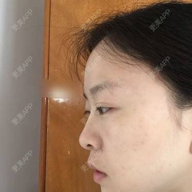 更美 - 自体脂肪丰下巴+自体脂肪丰面颊+太阳穴脂肪填充的日记 | 自体脂肪垫下巴 | 自体脂肪丰面颊 | 自体脂肪丰太阳穴 | 武汉