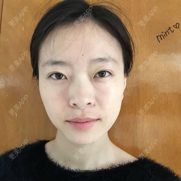 更美 - 自体脂肪丰下巴+自体脂肪丰面颊+太阳穴脂肪填充的日记 | 自体脂肪垫下巴 | 自体脂肪丰面颊 | 自体脂肪丰太阳穴 | 武汉