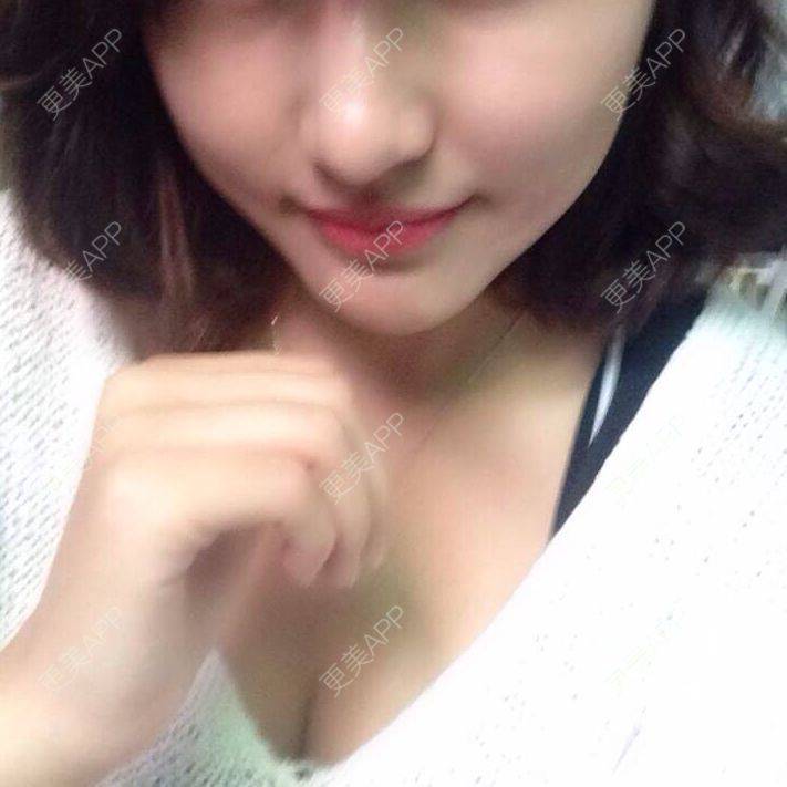 更美 - エイリ的全切双眼皮经验 | 全切双眼皮 | 埋线双眼皮 | 开外眼角 | 内切去眼袋 | 自体脂肪填充泪沟 | 切眉 | 自体脂肪淡化黑眼圈 | 除皱瘦脸 | 自体脂肪丰苹果肌 | 自体脂肪垫下巴 | 硅胶垫下巴 | 酒窝成形 | 自体脂肪丰面颊 | 自体脂肪丰额头 | 光子嫩肤 | 假体隆胸 | 硅胶隆鼻 | 厦门