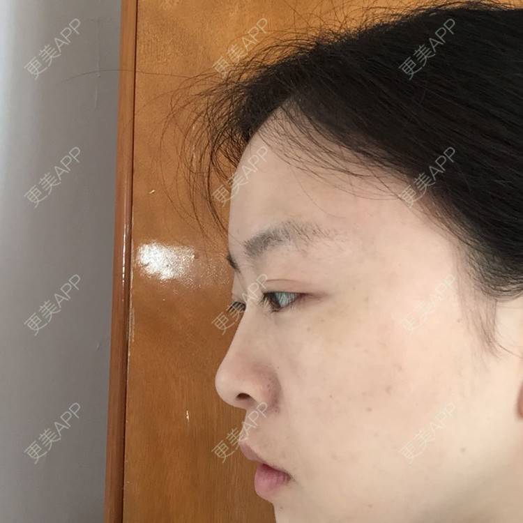 更美 - 自体脂肪丰下巴+自体脂肪丰面颊+太阳穴脂肪填充的日记 | 自体脂肪垫下巴 | 自体脂肪丰面颊 | 自体脂肪丰太阳穴 | 武汉
