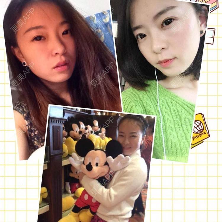 更美 - 自体脂肪丰下巴+自体脂肪丰面颊+太阳穴脂肪填充的日记 | 自体脂肪垫下巴 | 自体脂肪丰面颊 | 自体脂肪丰太阳穴 | 武汉