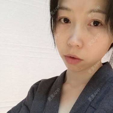 更美 - 吸脂祛眼袋+自体脂肪黑眼圈+自体脂肪泪沟+自体脂肪卧蚕+自体脂肪丰额头+自体脂肪丰下巴+太阳穴脂肪填充+龅牙+隐形矫正+胶原蛋白填充祛法令纹的日记 | 外切去眼袋 | 自体脂肪丰卧蚕 | 自体脂肪填充泪沟 | 自体脂肪淡化黑眼圈 | 自体脂肪垫下巴 | 自体脂肪丰太阳穴 | 自体脂肪丰额头 | 胶原蛋白改善法令纹 | 龅牙 | 苏州